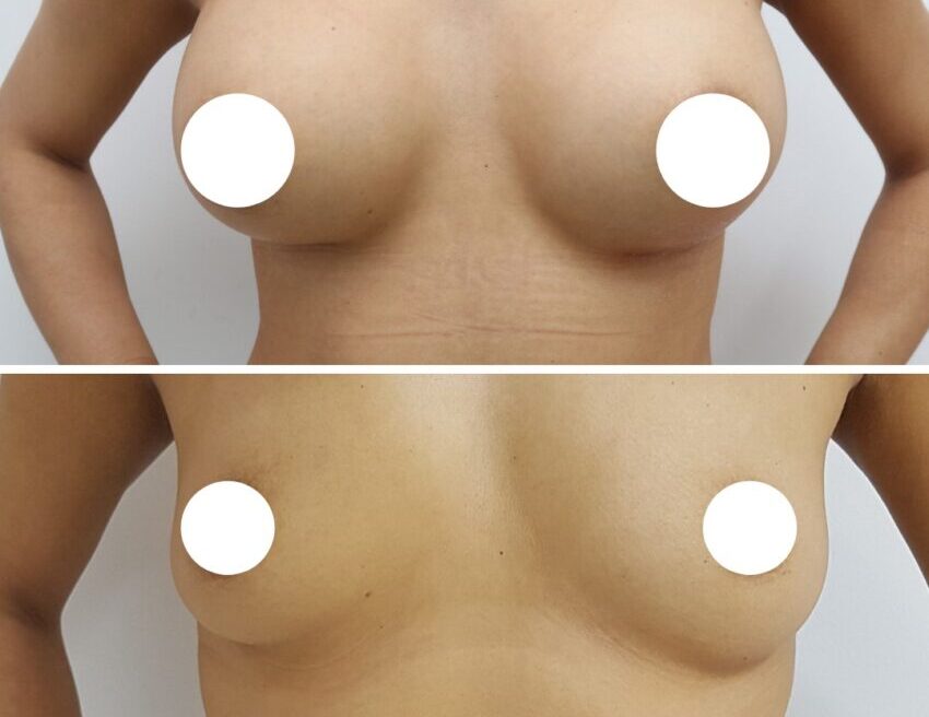 Augmentarea mamară, o operaţie vedetă