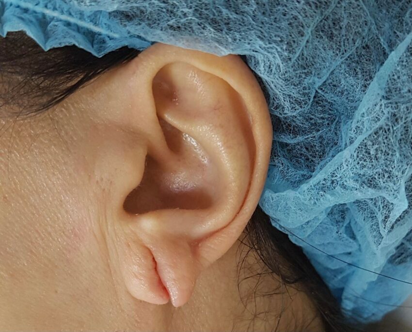 Probleme la nivelul lobului urechii.  Tot ce trebuie să ştiţi despre operaţia de corectare a urechilor despicate