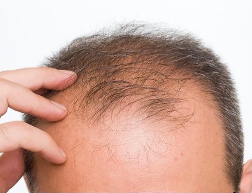 Căderea părului la bărbați. Care sunt cauzele care duc aici, cum preveniți această problemă, dar și ce soluție au specialiștii?